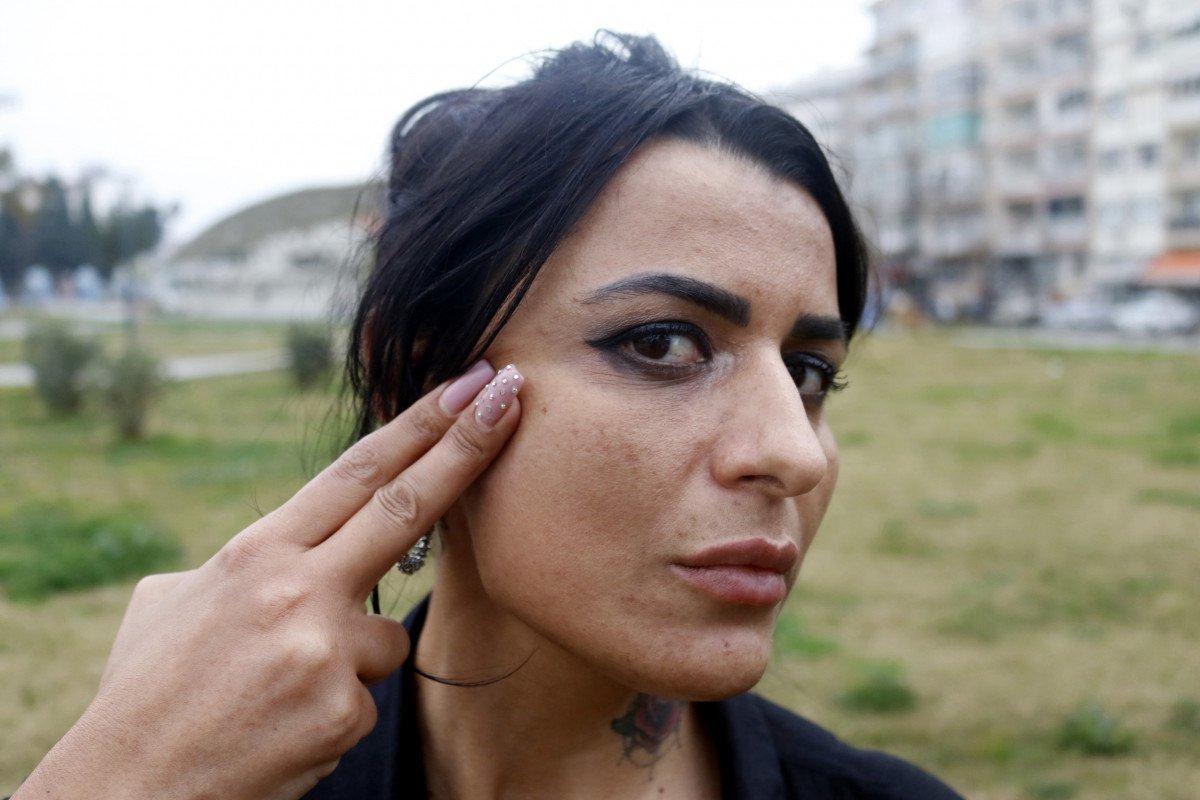 Antalya'da lazerde yüzü yanan kadının davasında sonuç çıktı