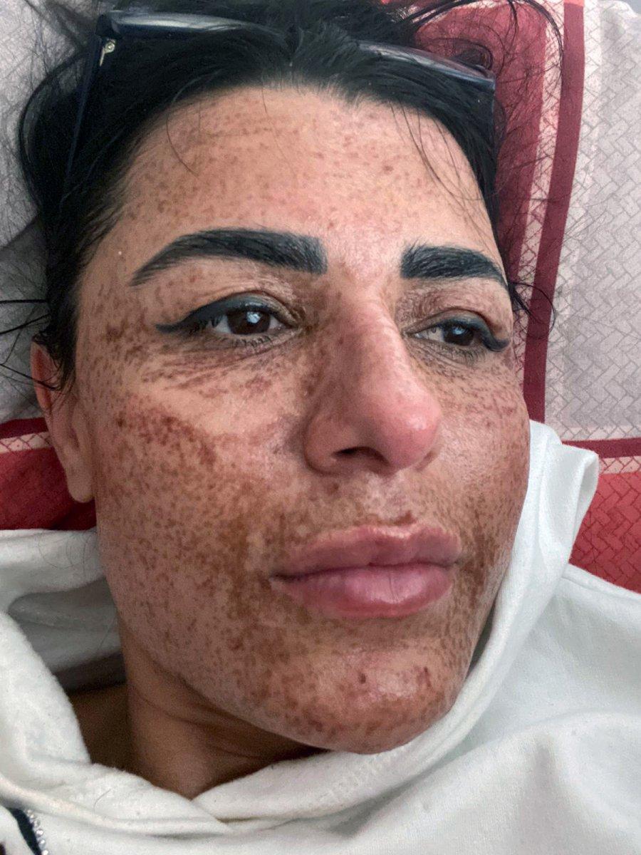 Antalya'da lazerde yüzü yanan kadının davasında sonuç çıktı