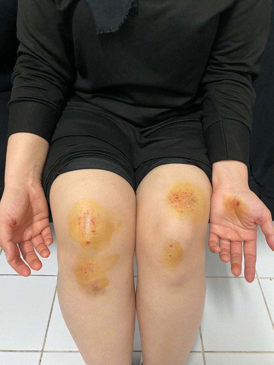 Malatya’da işe giderken köpeklerin saldırdığı kadın yaralandı