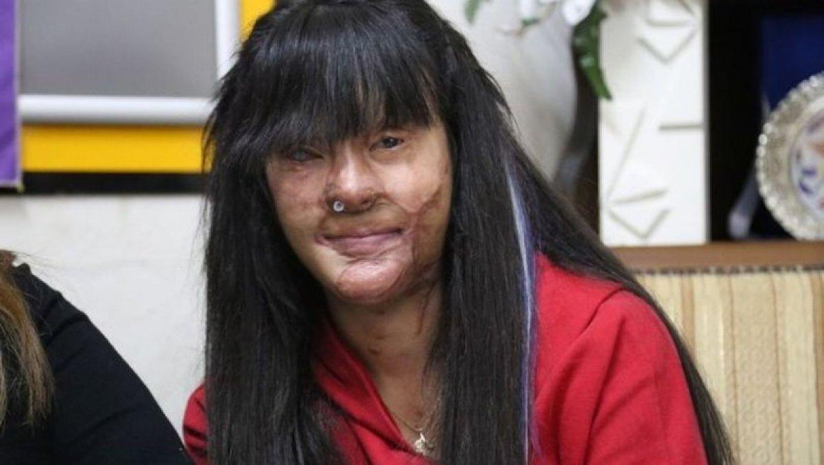 Berfin Özek, yüzünü asitle yakan Ozan Çeltik'le evlendi