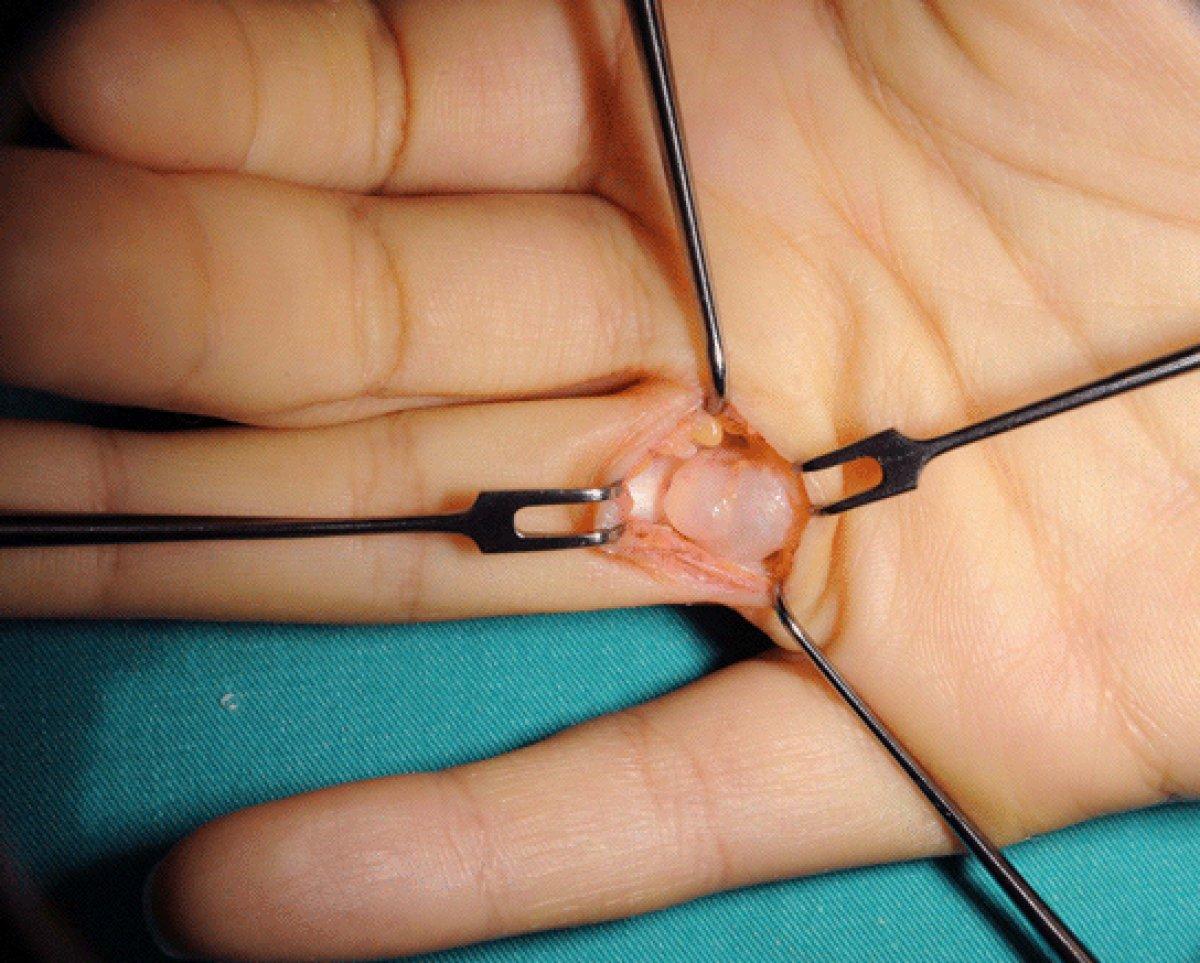 El bileğinizi kontrol edin: Ganglion kisti nedir, nasıl anlaşılır?