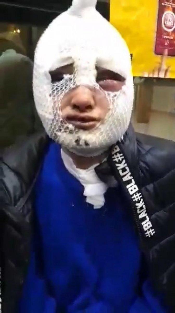 Hatay'da eski sözlüsü tarafından darbedilip, başından aşağı kızgın yağ döküldü