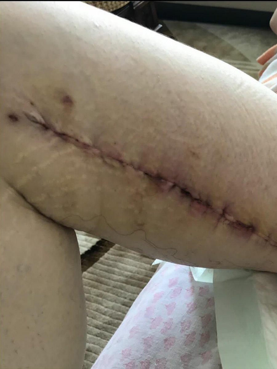 İzmir’de 3 kez bıçak altına yatan kadın, estetik mağduru oldu