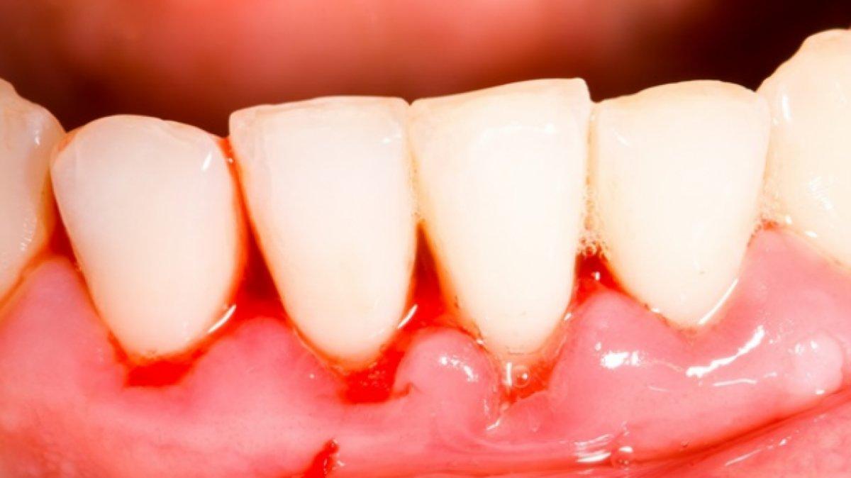 Vitamin eksikliklerinin gözle görülen 8 belirtisi