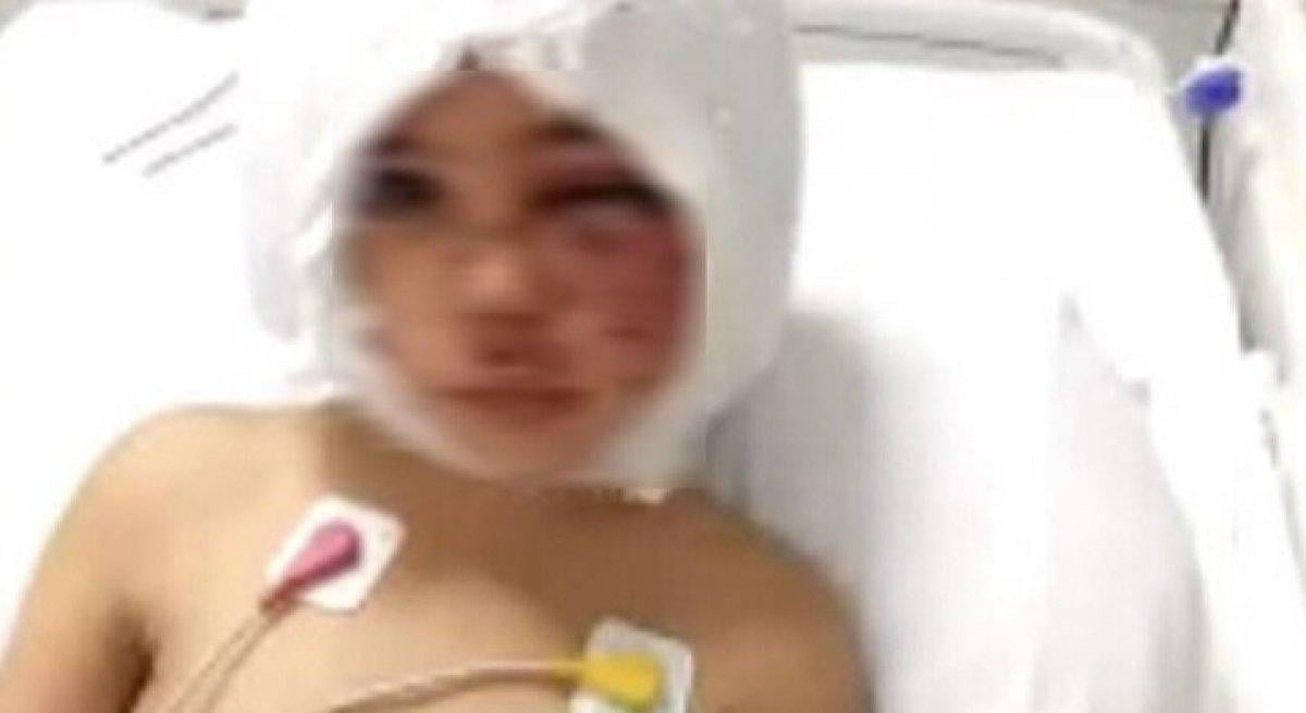 Gaziantep'te pitbullun ısırdığı Asiye'nin doktoru, bilgilendirme yaptı