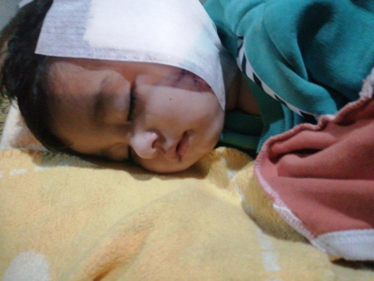 Antalya'da 2,5 ay önce pitbull saldırısına uğrayan küçük Sadrettin