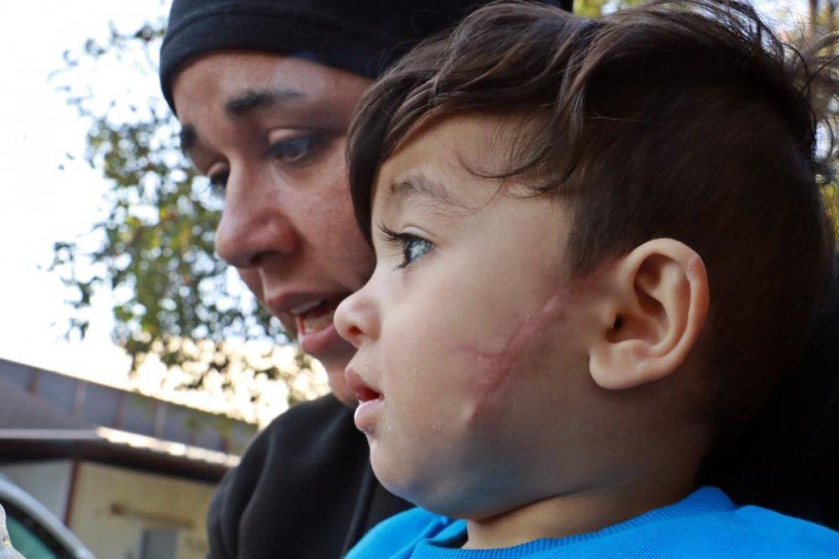 Antalya'da 2,5 ay önce pitbull saldırısına uğrayan küçük Sadrettin