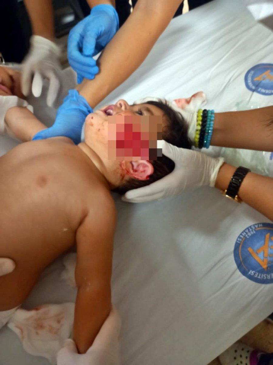 Antalya'da 2,5 ay önce pitbull saldırısına uğrayan küçük Sadrettin