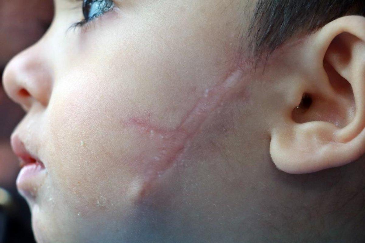 Antalya'da 2,5 ay önce pitbull saldırısına uğrayan küçük Sadrettin