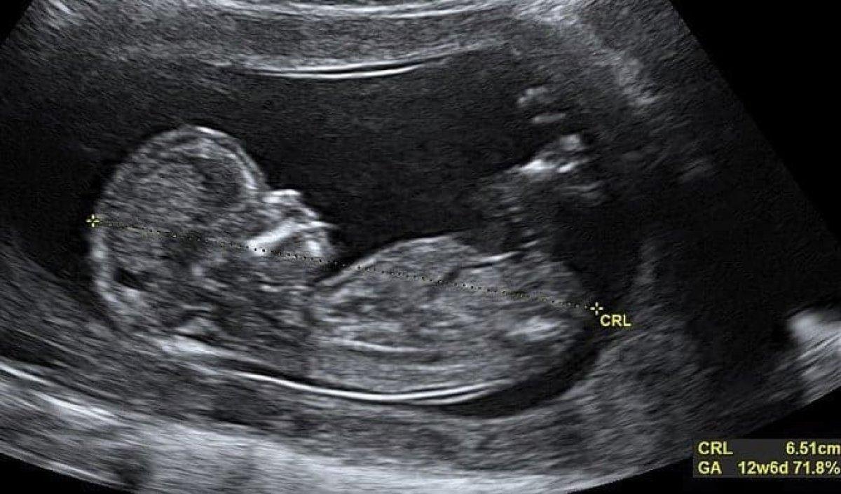 Annelerin merakı: Ultrasonda 'CRL' ne demek?