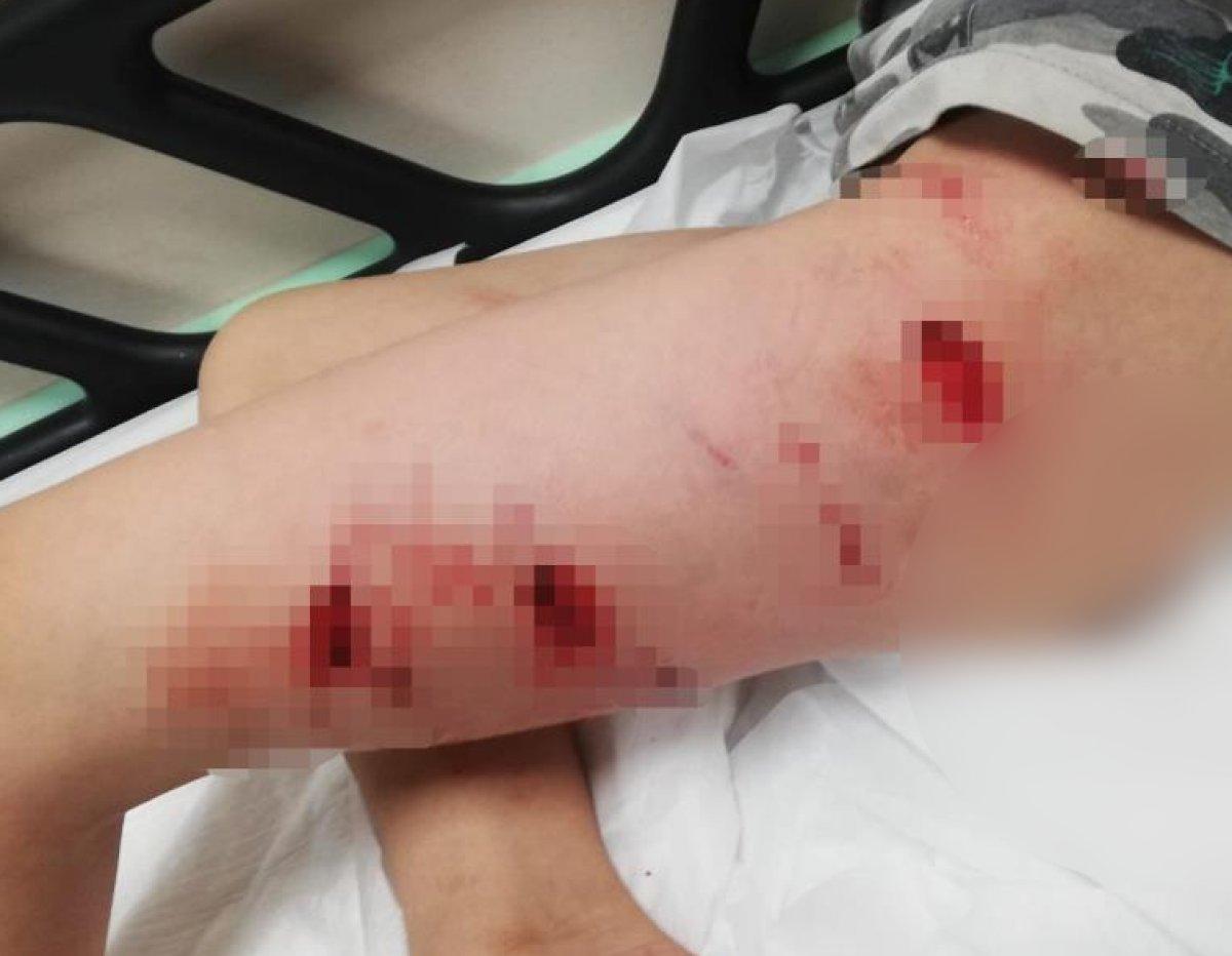 İzmir'de pitbull saldırısı: Sahibi tasmayı bırakınca yaraladı