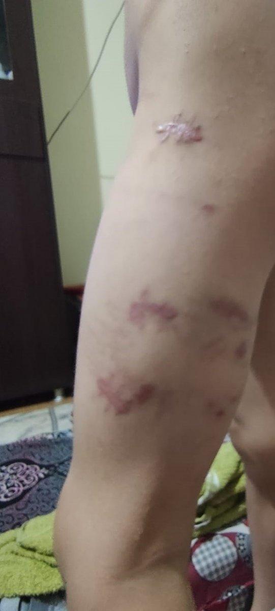 İzmir'de pitbull saldırısı: Sahibi tasmayı bırakınca yaraladı