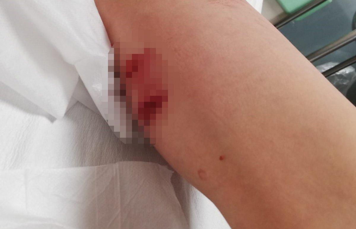 İzmir'de pitbull saldırısı: Sahibi tasmayı bırakınca yaraladı