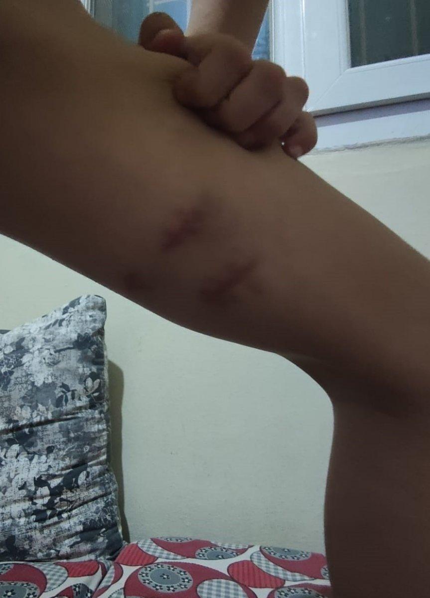 İzmir'de pitbull saldırısı: Sahibi tasmayı bırakınca yaraladı