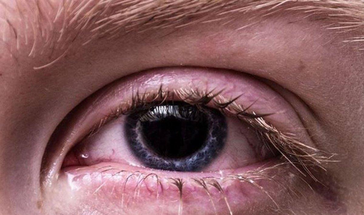Kaşıntı, yanma, kızarıklık! Gözlerde 'adenovirüs' semptomları....