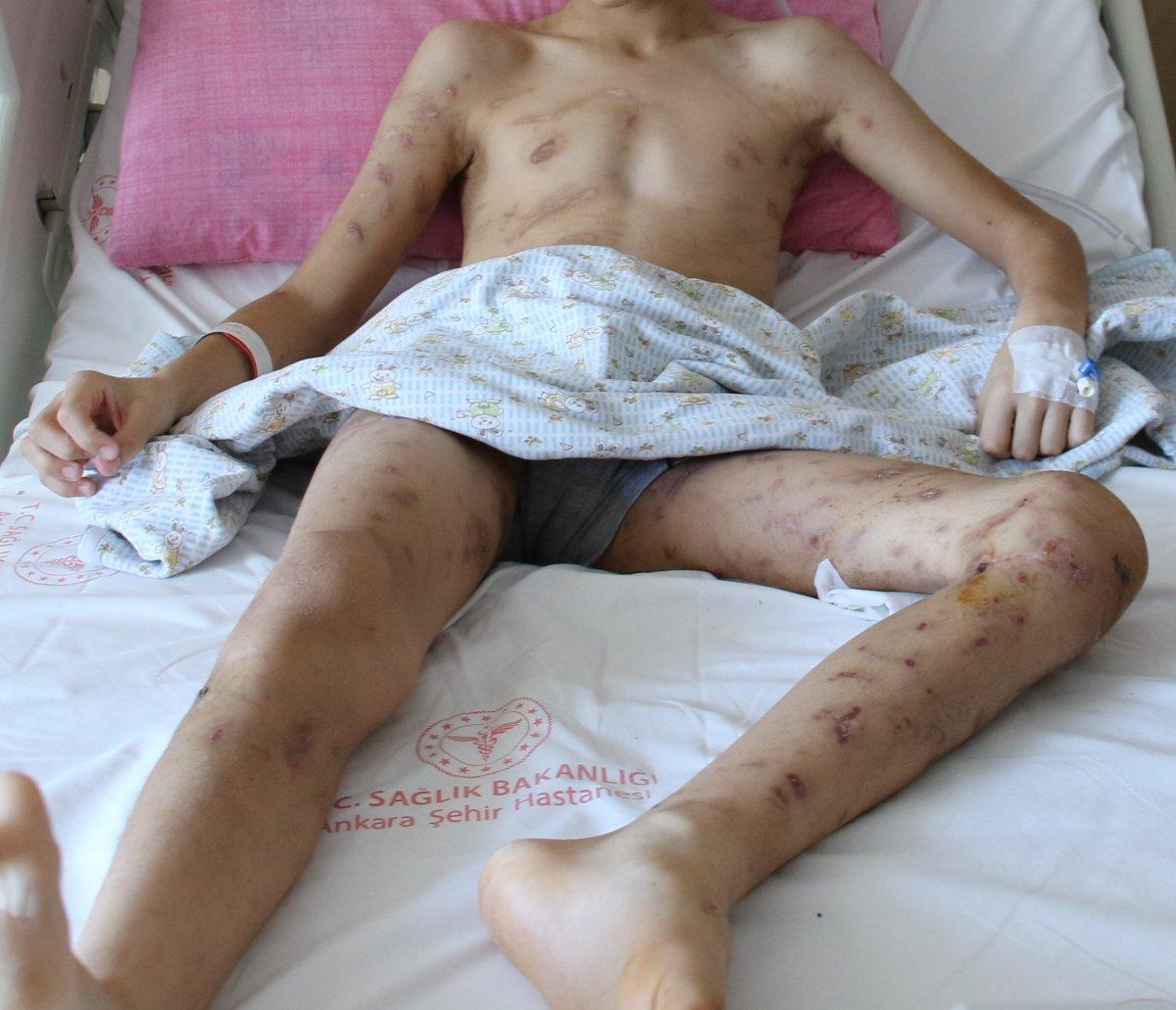 Ankara'da köpek saldırısına uğrayan Enes'in son hali yürek burktu