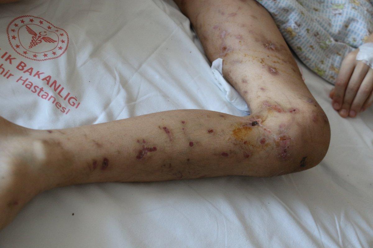 Ankara'da köpek saldırısına uğrayan Enes'in son hali yürek burktu