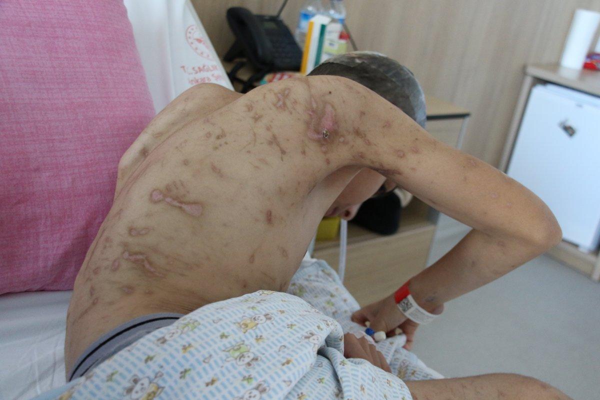 Ankara'da köpek saldırısına uğrayan Enes'in son hali yürek burktu