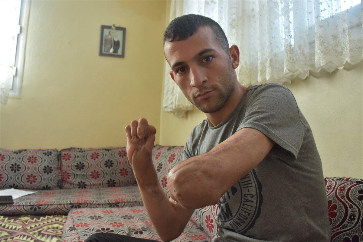 Adanalı genç, protez desteği bekliyor