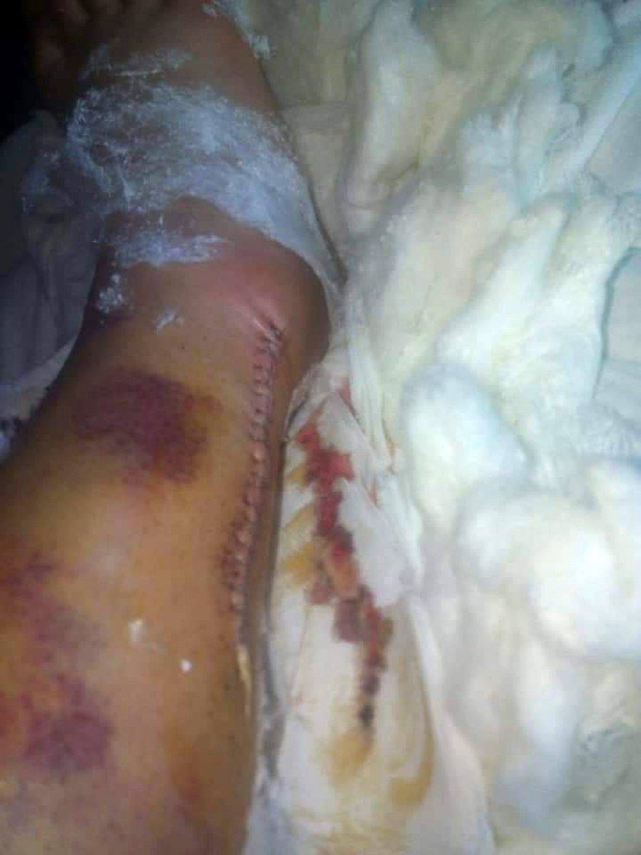 Adana'da hem ayağından hem işinden oldu, 45 bin TL tazminat aldı