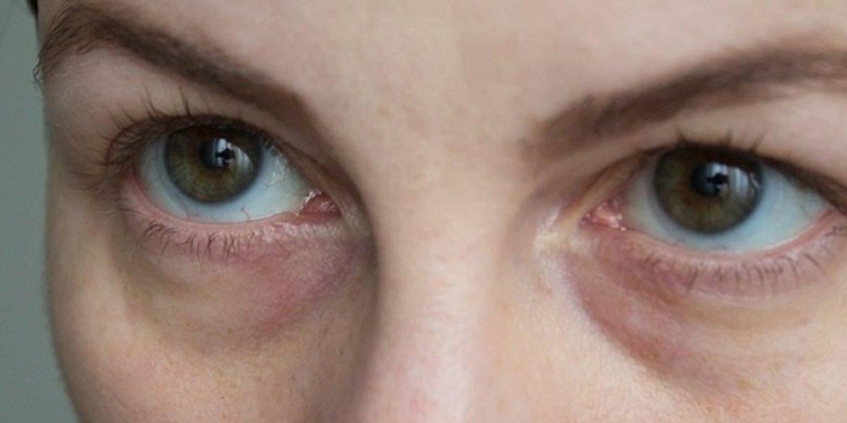 Göz altlarımız neden morarır? Sebebi o pigmentte gizli...