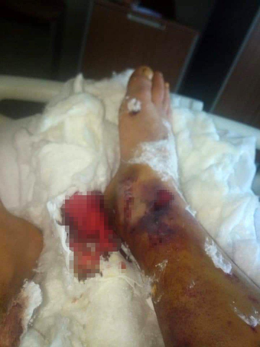 Adana'da hem ayağından hem işinden oldu, 45 bin TL tazminat aldı