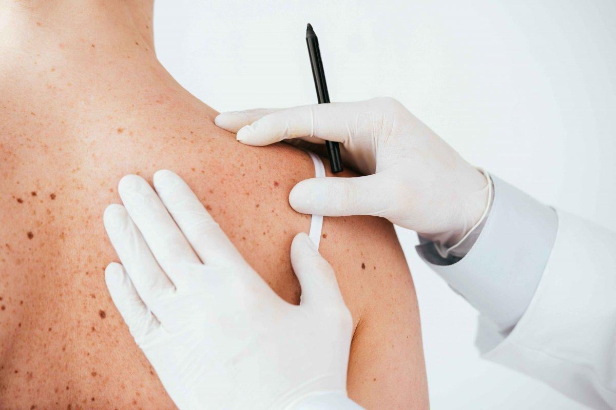 Sırttaki sivilcelerin nedenleri ve kurtulmak için 5 ipucu