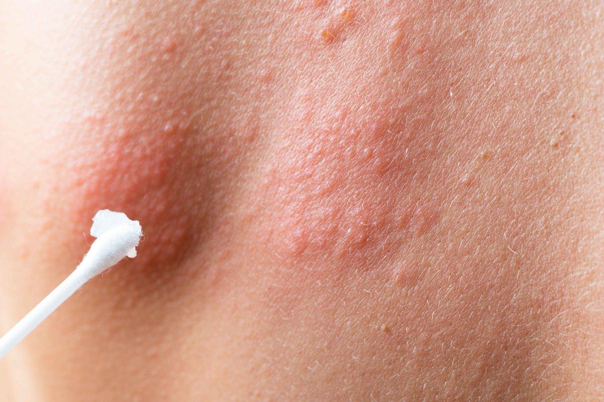 Sırttaki sivilcelerin nedenleri ve kurtulmak için 5 ipucu