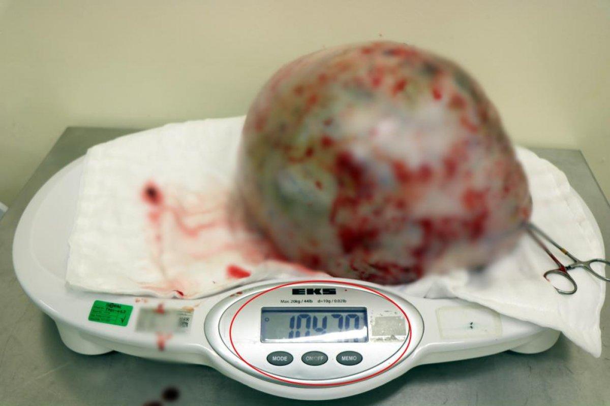 Samsun’da, kadının karnından 10 kilo 470 gram kitle çıkarıldı