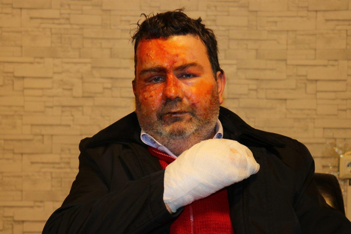 Sakarya'da, uykudayken yüzüne yanıcı madde döküldü