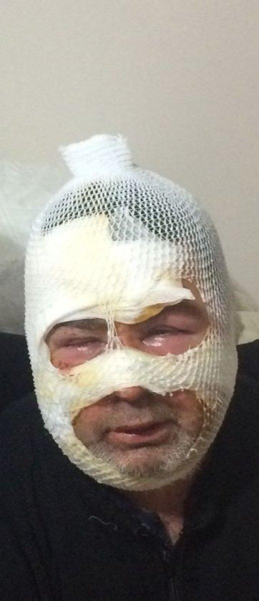 Sakarya'da, uykudayken yüzüne yanıcı madde döküldü