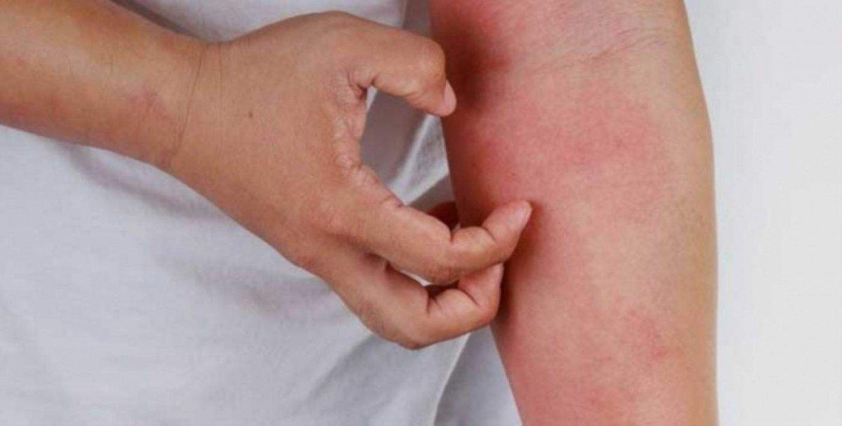 'Soğuktan kaşınıyorum' diyenler dikkat! O hastalığın habercisi...