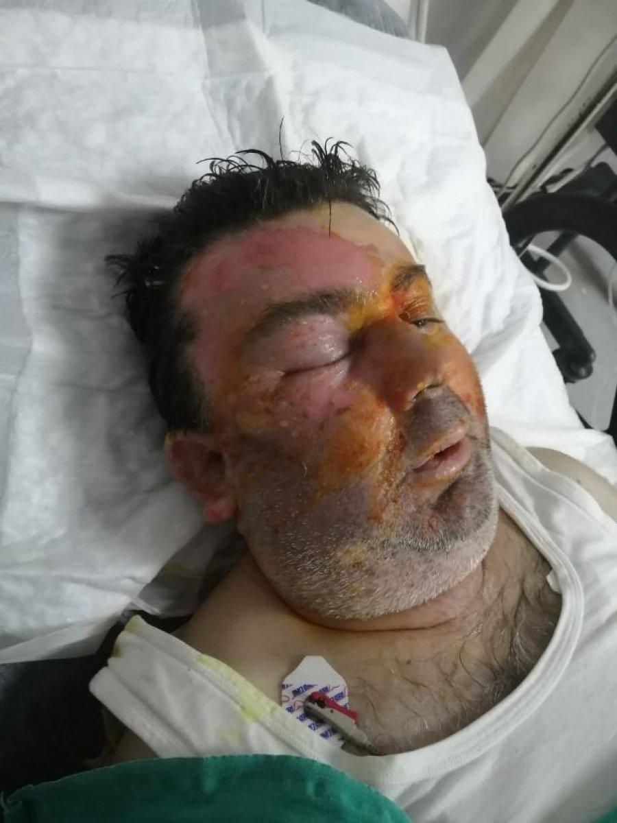 Sakarya'da, uykudayken yüzüne yanıcı madde döküldü