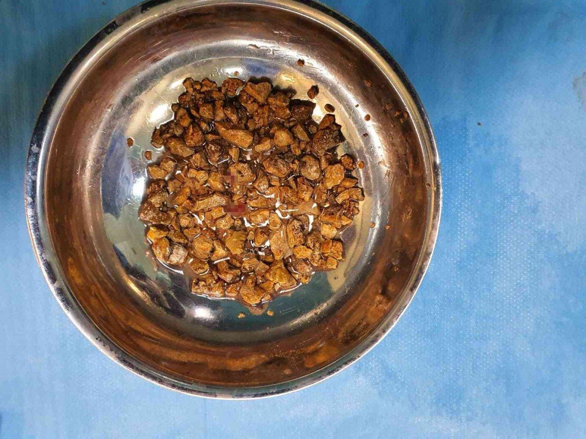 Sakarya’da, böbreğinden 1.200 taş çıkarıldı