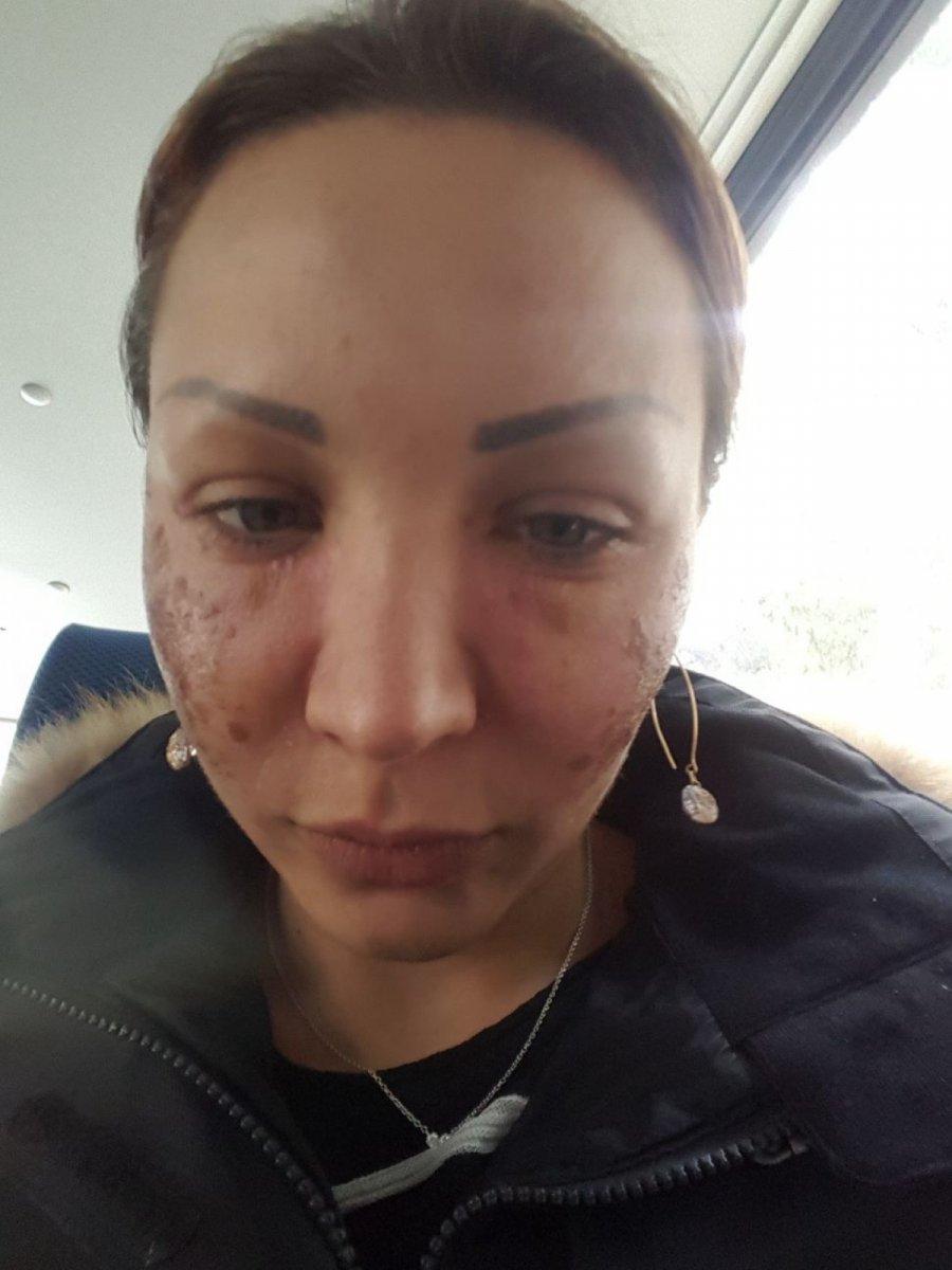 İstanbul’da örümcek estetiği iddiasına savunma