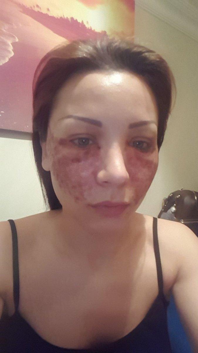 İstanbul’da örümcek estetiği iddiasına savunma