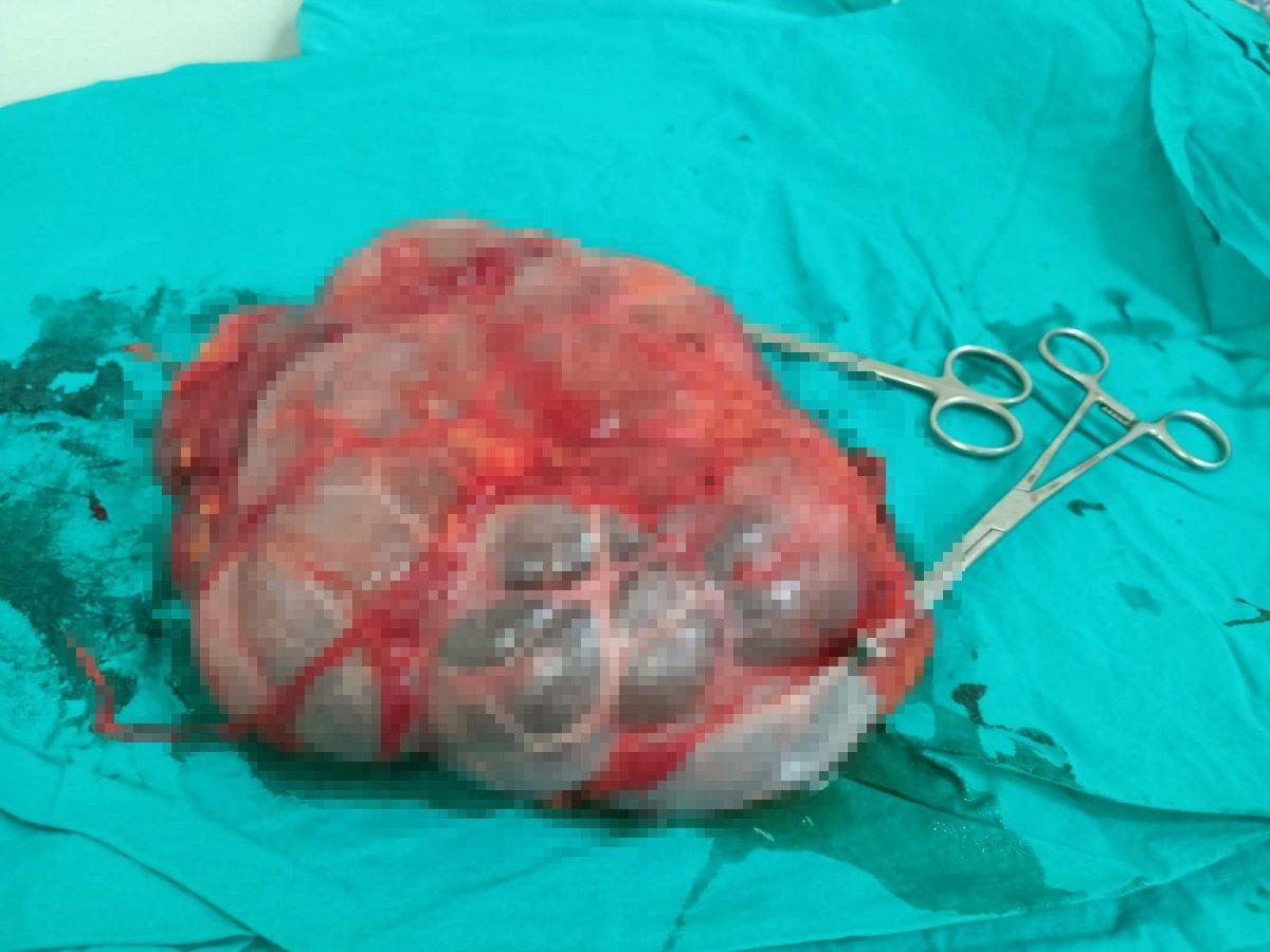 Denizli'de idrar kesesine dönüşen böbrek ameliyatla alındı