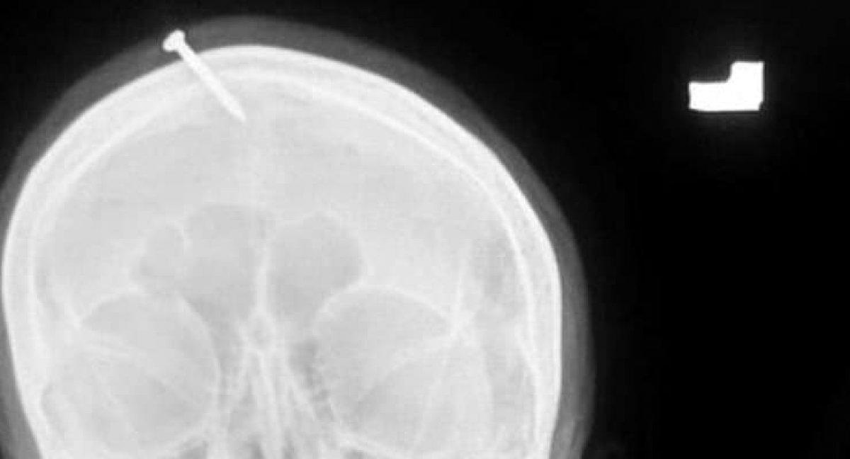 Pakistan'da hamile kadının kafasına erkek çocuk için çivi çaktılar