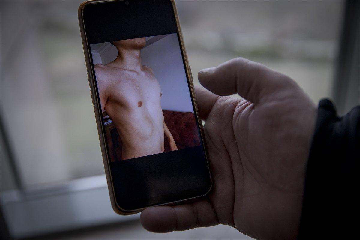 Ankara'da, kunduracı göğsü hastalığından kapalı ameliyat ile kurtuldu