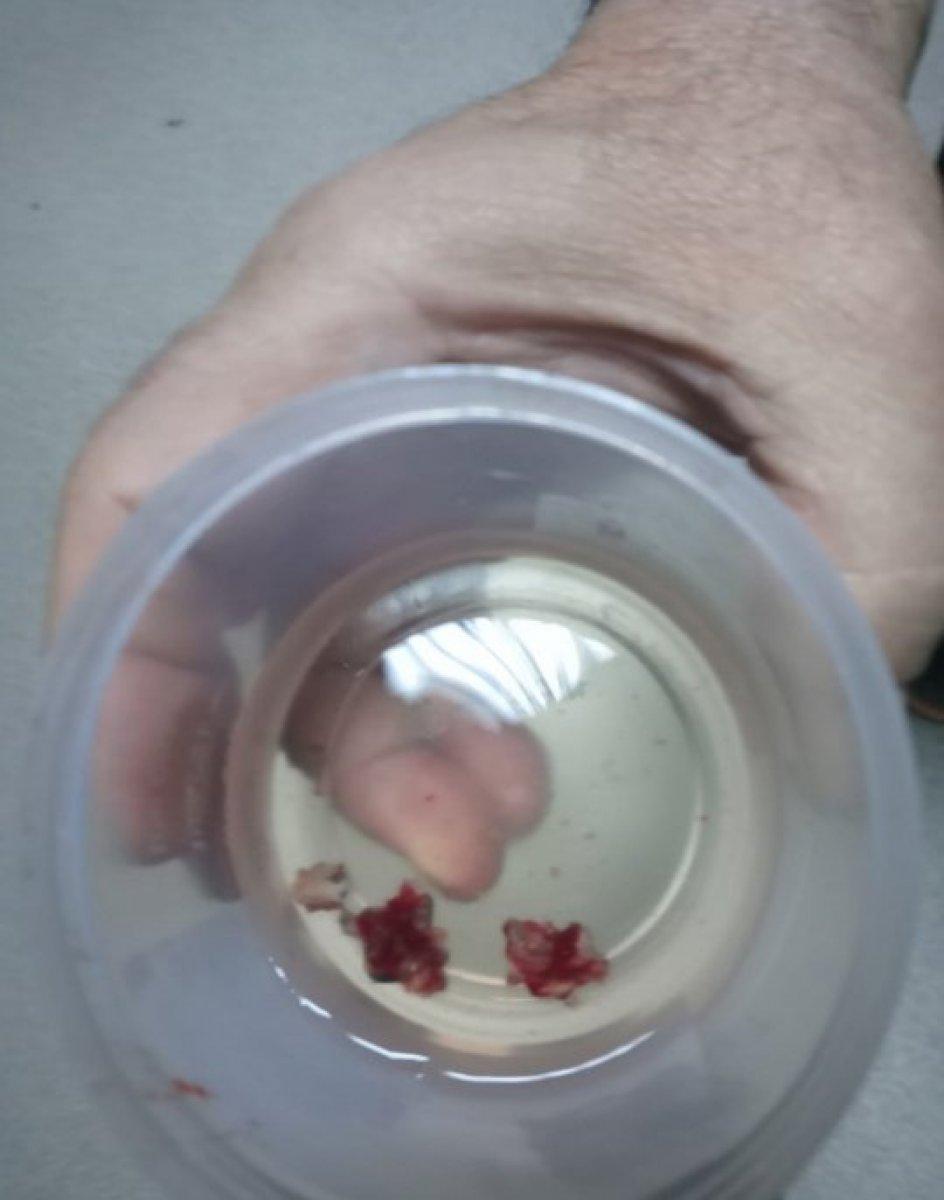 Adana’da baş ağrısıyla gittiği hastanede, burnundan taş çıkarıldı