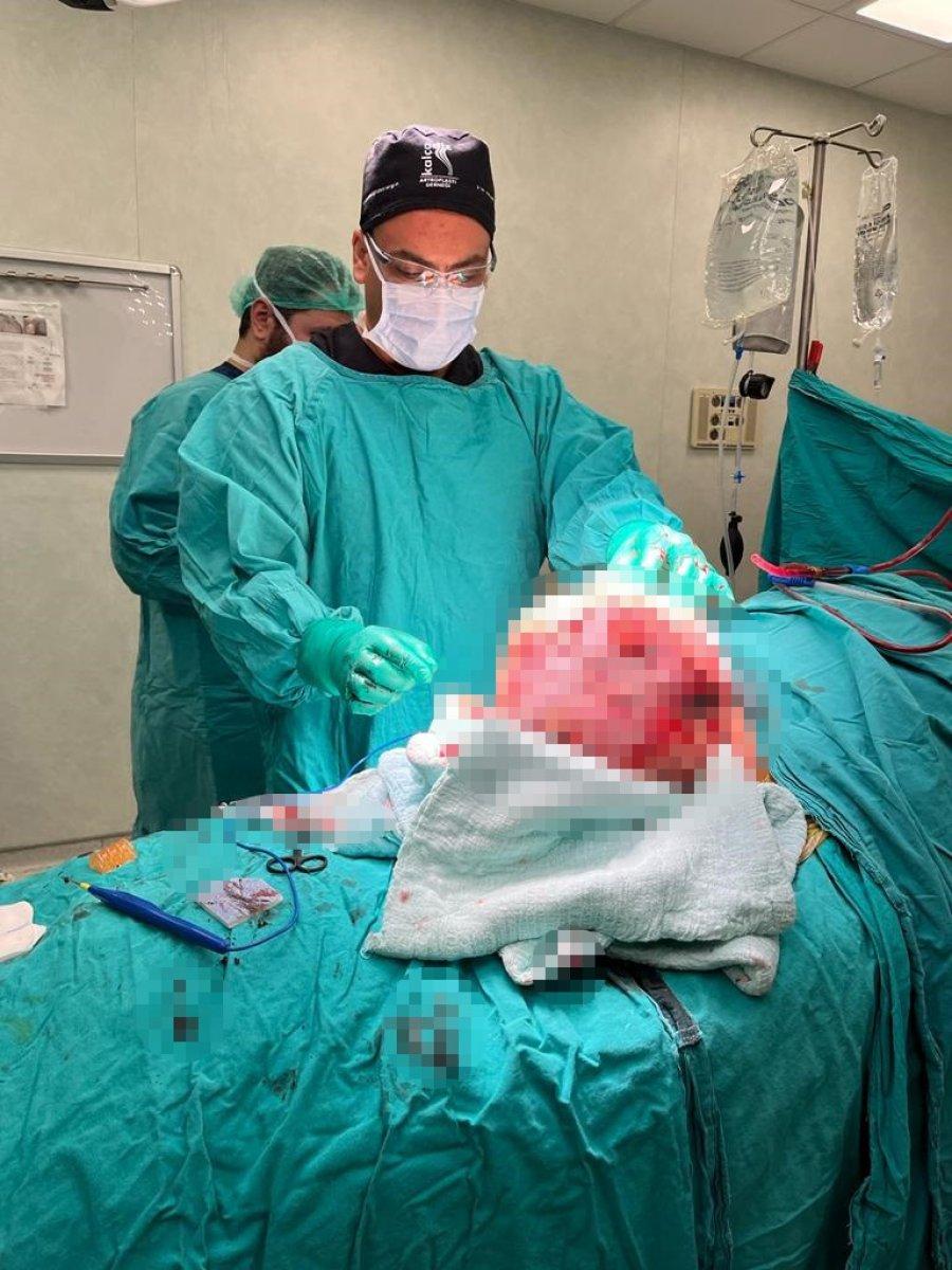 Şanlıurfa'da hastanın kalçasından 10 kilo tümör çıktı