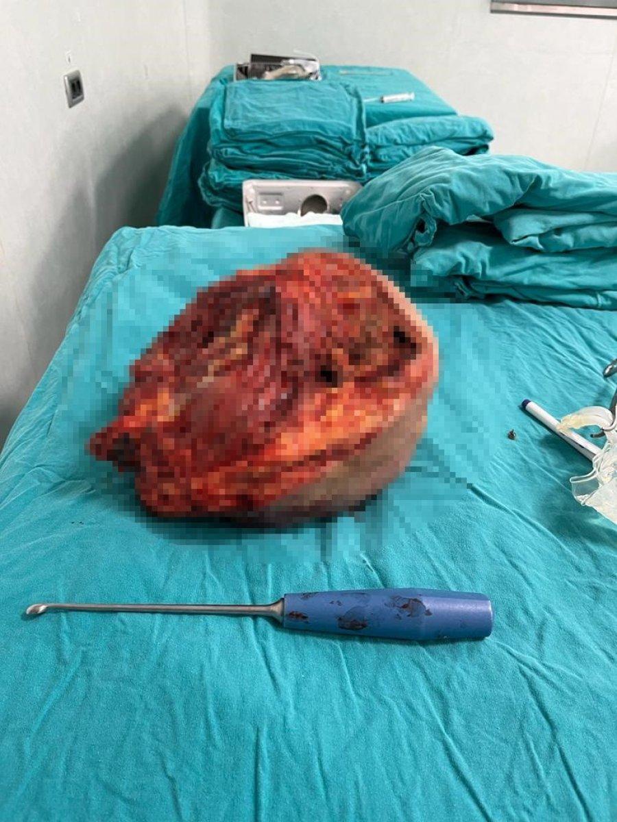 Şanlıurfa'da hastanın kalçasından 10 kilo tümör çıktı