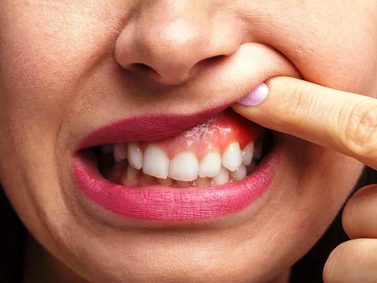 Kanayan diş etlerinin sebebi: Gingivit nedir