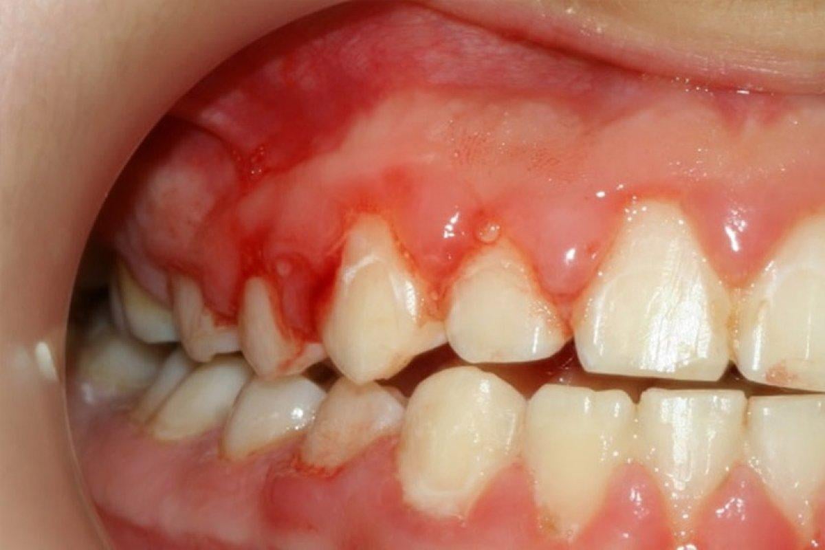Kanayan diş etlerinin sebebi: Gingivit nedir