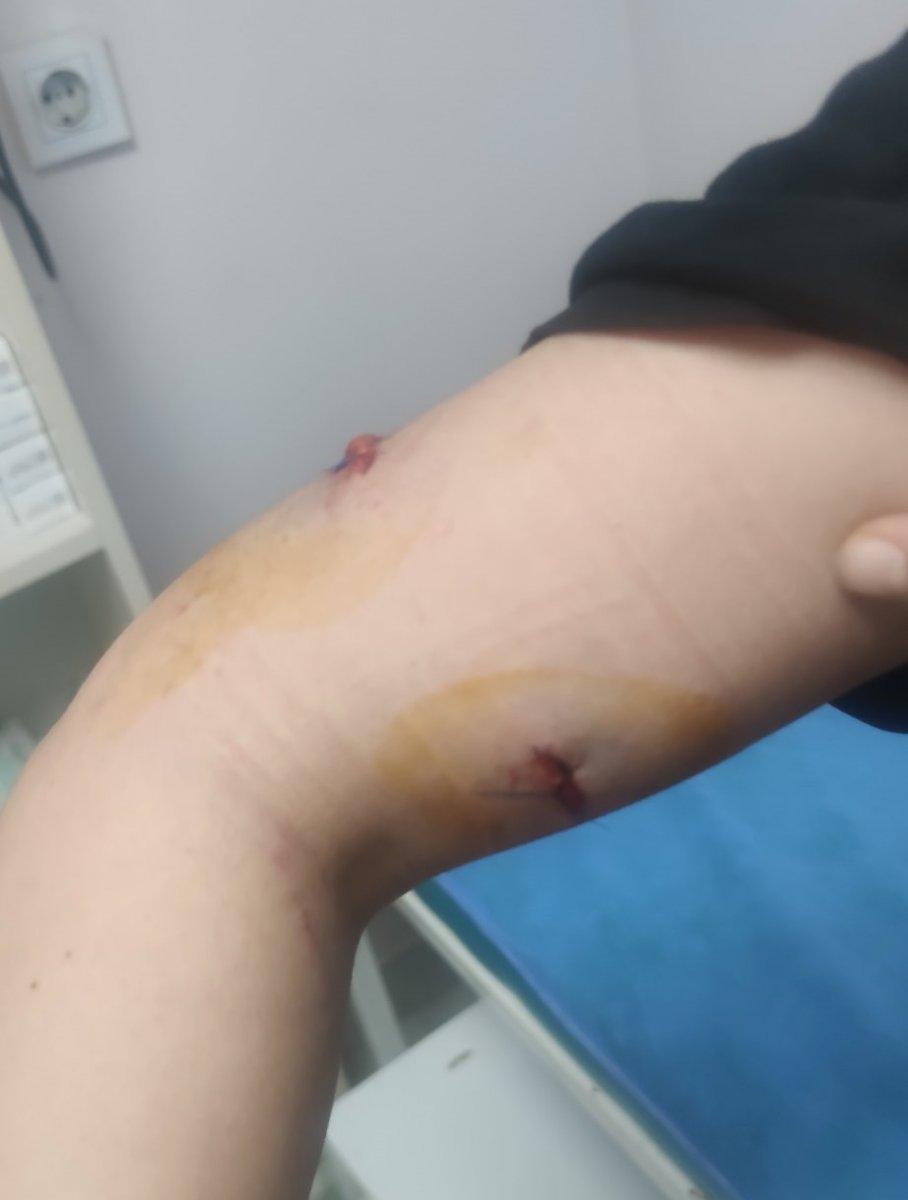 Gaziantep’te bahçeden kaçan köpek, kadına saldırdı