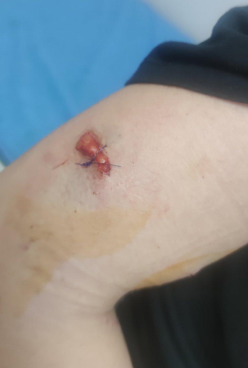 Gaziantep’te bahçeden kaçan köpek, kadına saldırdı