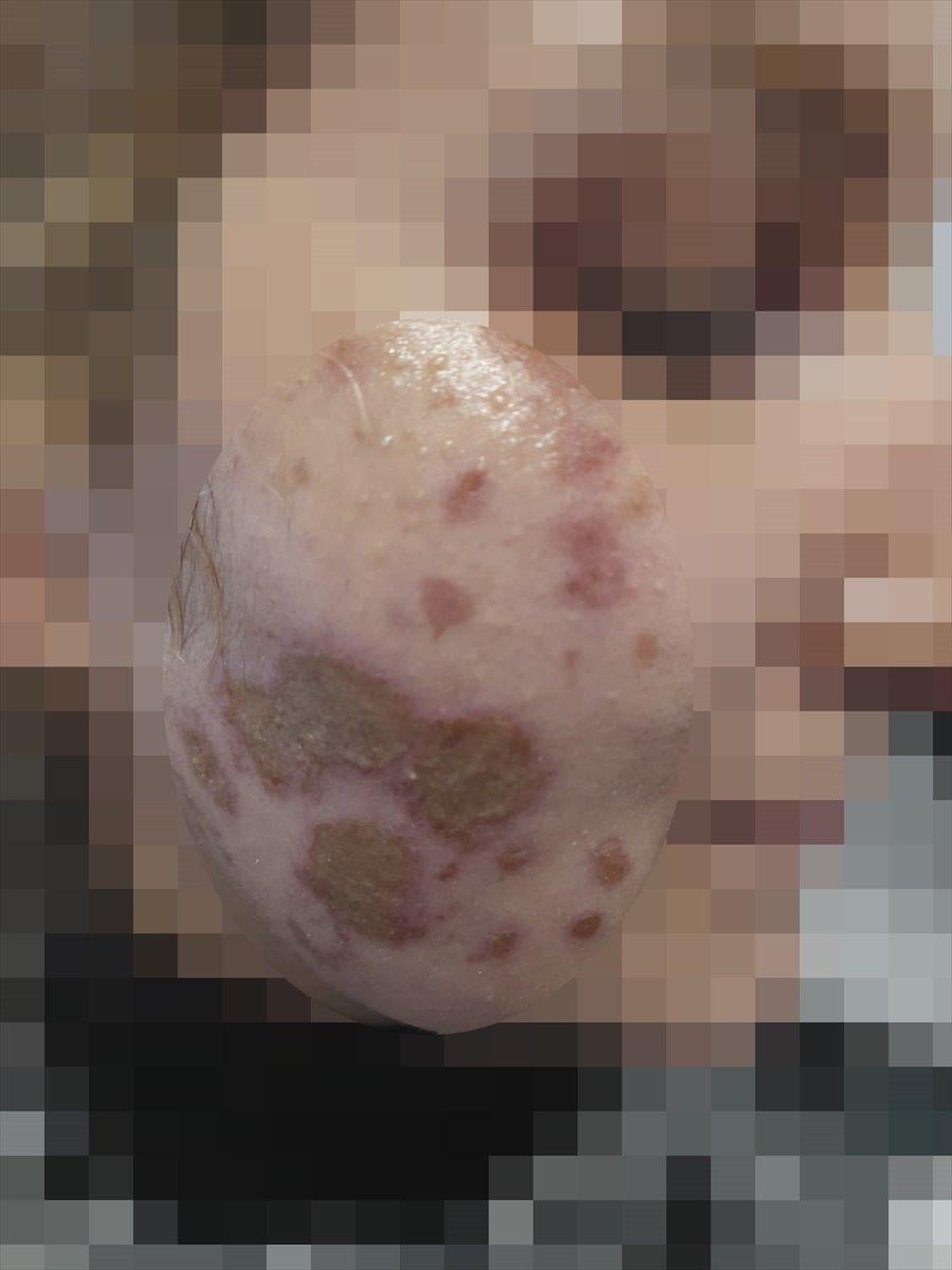 Ankara'da yüzüne kezzap atılan kadın yaşadıklarını anlattı