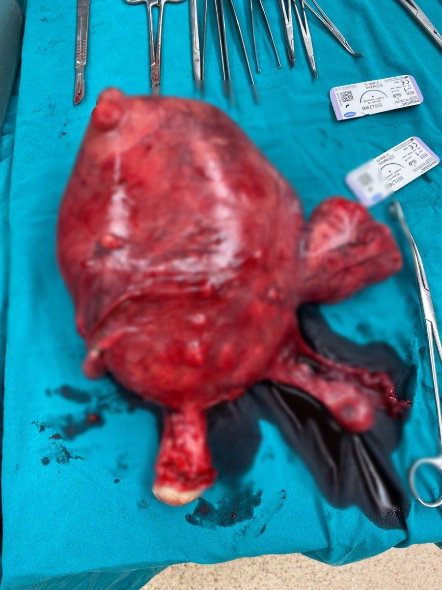 Kars'ta karnından ameliyatla 5 kiloluk kitle alındı