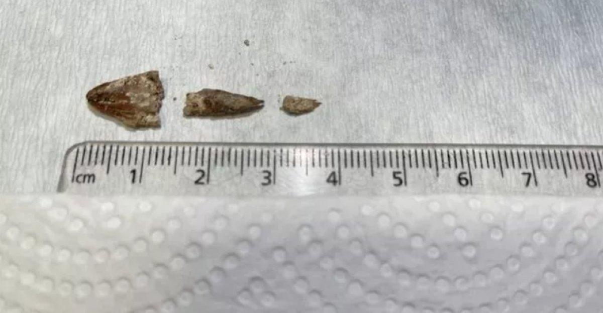 İzmir'de kanser zannedilen hastanın soluk borusundan badem kabuğu çıktı