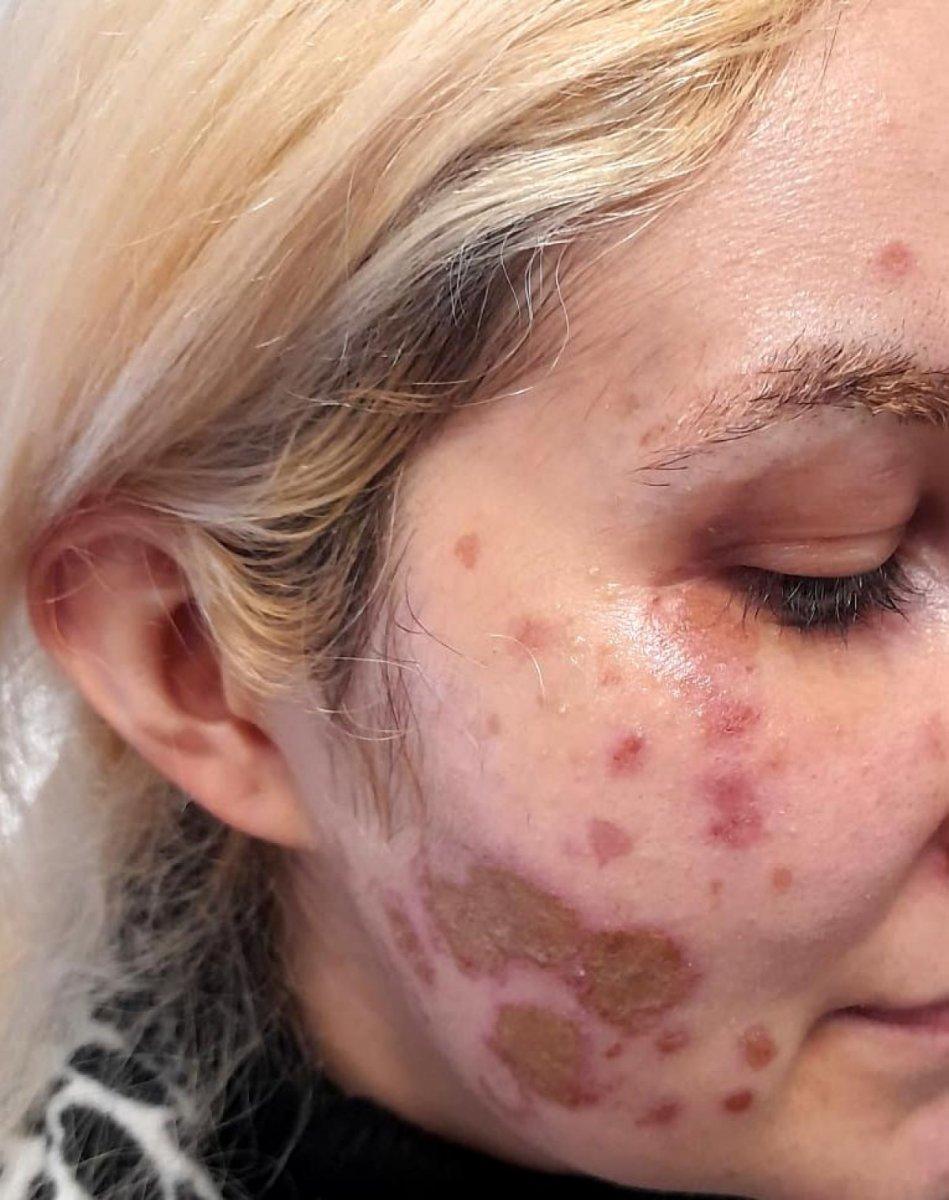 Ankara’da, kadının yüzüne kimyasal madde atan şahsın ev hapsi kaldırıldı